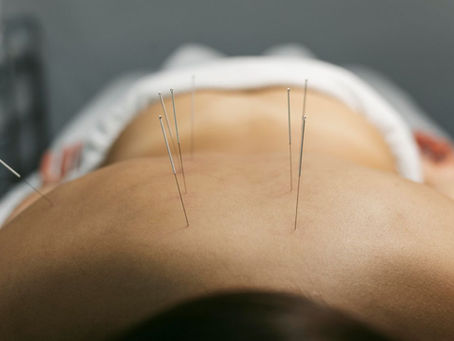 Acupuncture for PCOS in St. Charles, MO