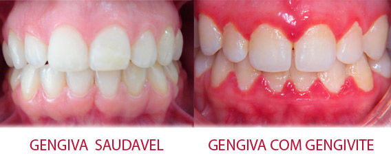 Gengivite - O que é? Será que eu tenho?