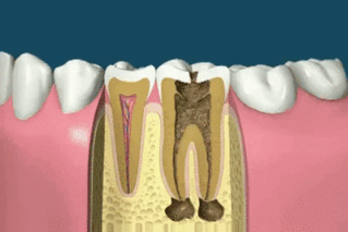 Root canal treatment