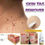 Thumbnail: Skin Tag Remover