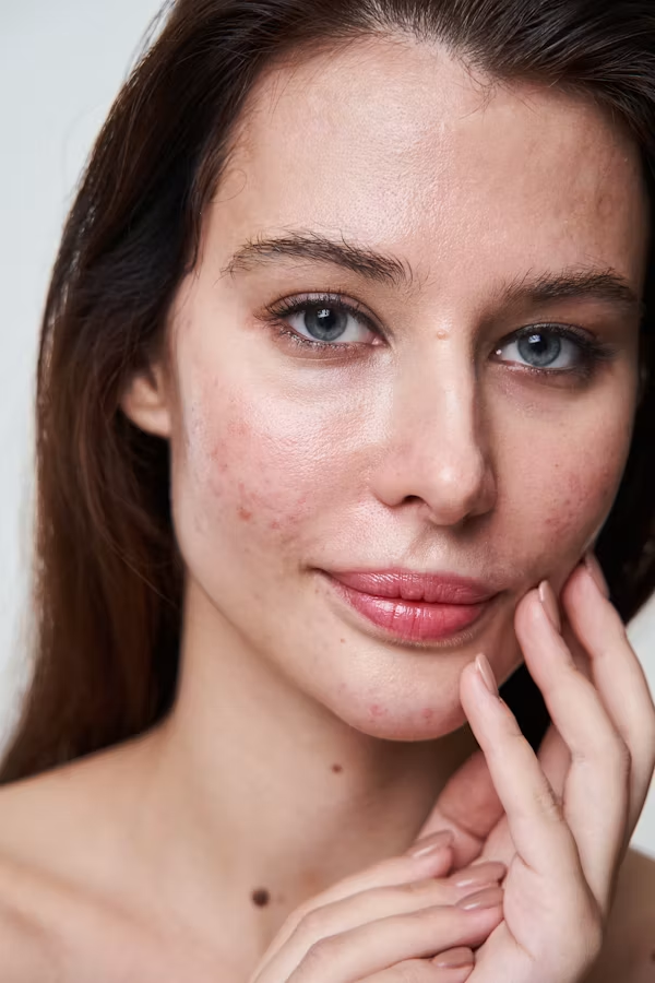 Can Doxycycline Help Clear Acne? Here Is What to Know