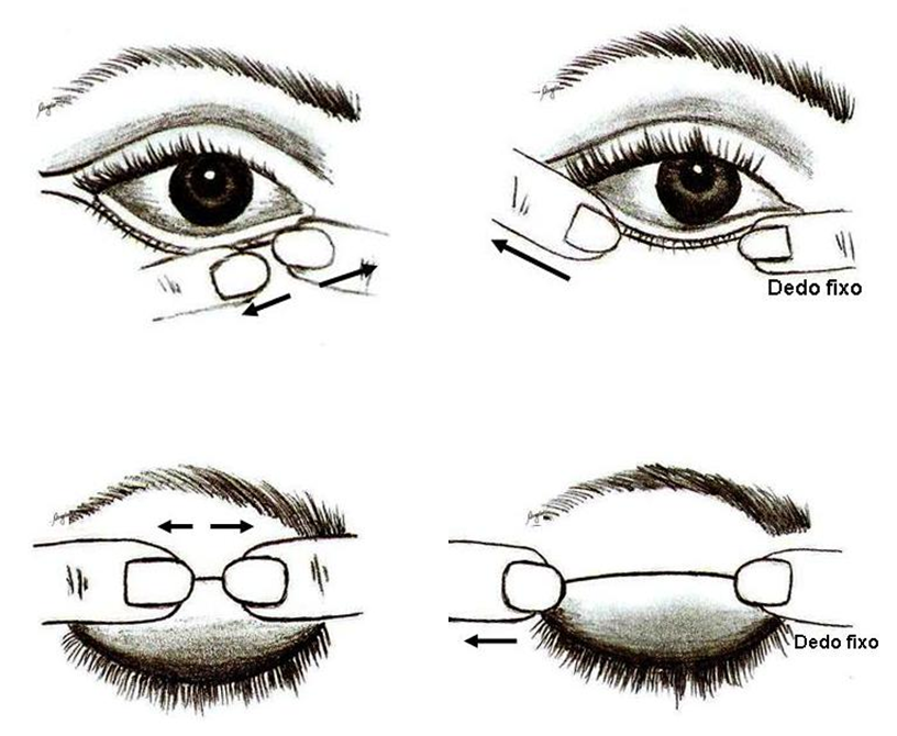 manipulação da cicatriz palpebral