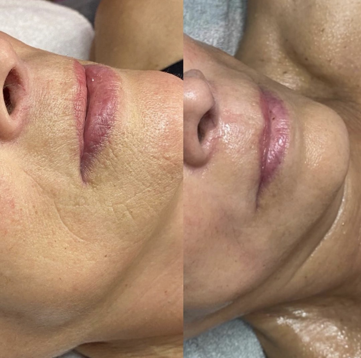 ematrix + jetpeel