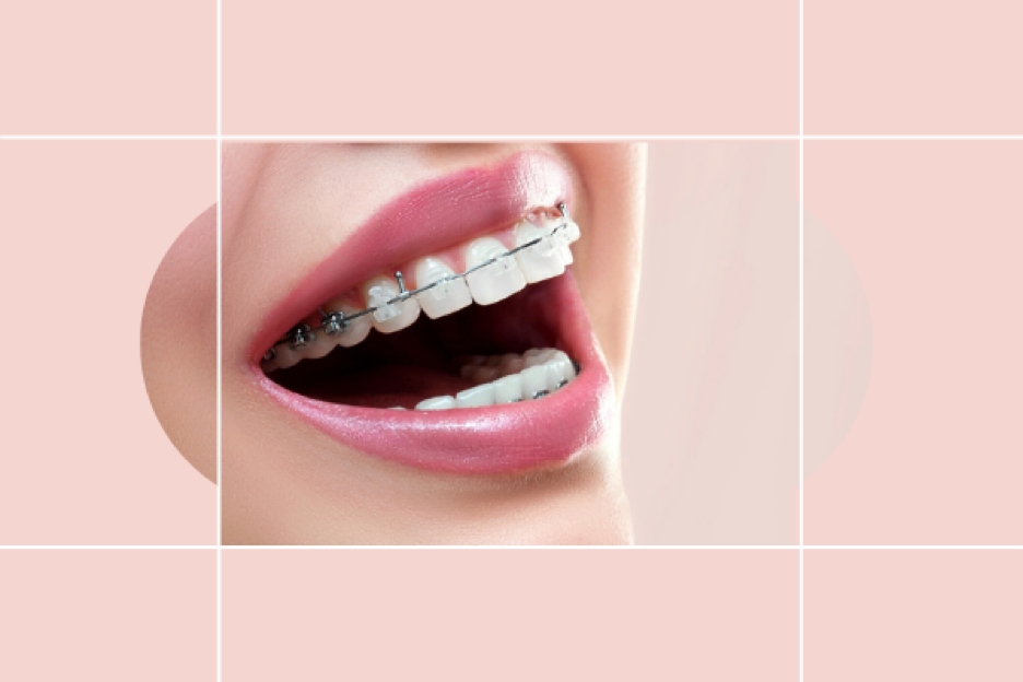 How to Determine If You Need Braces For Teeth Straightening