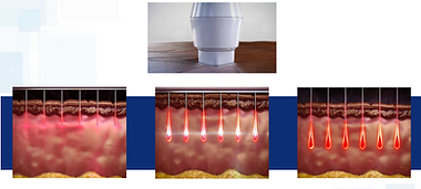 Illustration of how rf microneedling energy penetrates the skin