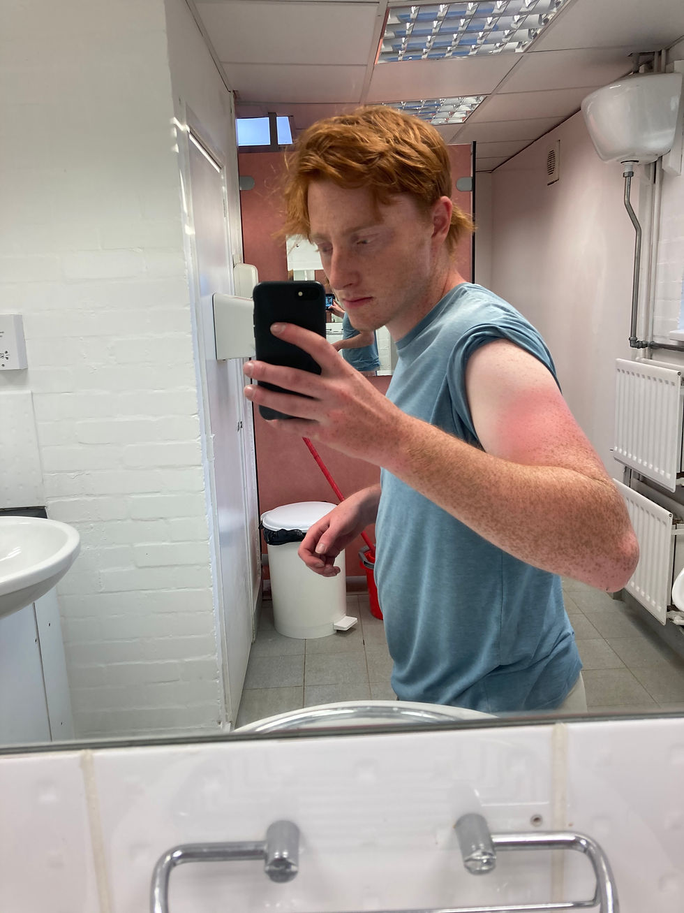 A sunburned me in a bathroom mirror.