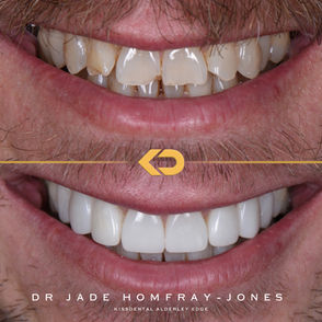 Composite veneers