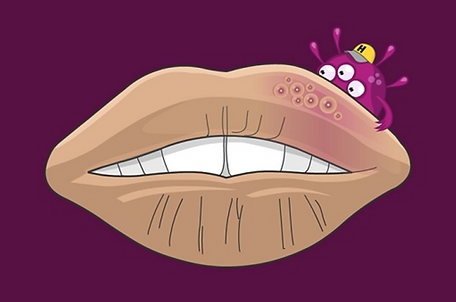 Herpes Happens cold sore image
