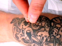 6 Dry Needling Questions Answered By Our Hamilton Osteopath