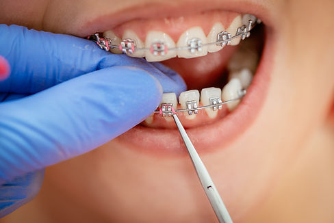 braces-2026-01-05-06-10-48-utc.jpg