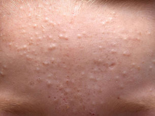 Asphyxiated skin close-up showing congestion and dull rough texture on the cheek — Korea 2 Cape Town