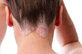 Korean skincare for psoriasis