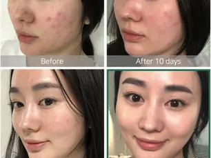 Acne before and after 10 days, Korea2CapeTown — clearer, calmer skin on cheeks and jawline