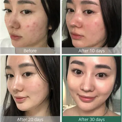 Acne before and after 10 days, Korea2CapeTown — clearer, calmer skin on cheeks and jawline