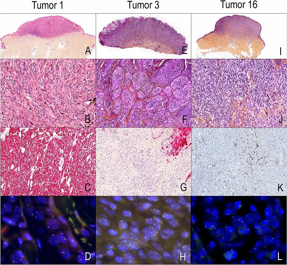Tumor histology for patients 1, 3 and 16 who had adverse outcomes. Tumor 1 (A–D) exhibits Spitz architecture (A, HES ×10) and fusiform Spitz cytology (B, HES ×200), with p16-positivity (C, p16 IHC ×100) and no 9p21 deletion (D, FISH ×600). Tumor 3 (E–H) was a compound Spitz tumor (E, HES ×10) with epithelioid Spitz cytology (F, HES ×200), loss of p16 (G, p16 IHC ×100) and heterozygous 9p21 deletion (H, FISH ×600). Tumor 16 (I–L) was a densely cellular melanocytic dermal tumor (I, HES ×10) with nevoid cytology (J, HES ×200), p16-negativity (K, p16 IHC ×100) and homozygous 9p21 deletion (L, FISH ×600)