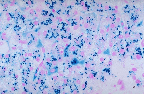 Liver sample stained with PERLS stain.