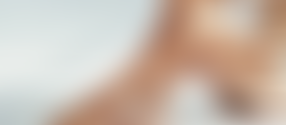 Spider Vein Solutions for Smooth, Confident Legs