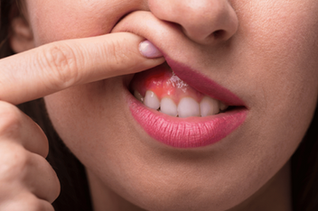 Can Castor Oil Reduce Gum Swelling and Infection? A Natural Remedy Explored