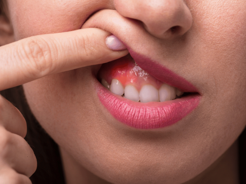 Can Castor Oil Reduce Gum Swelling and Infection? A Natural Remedy Explored