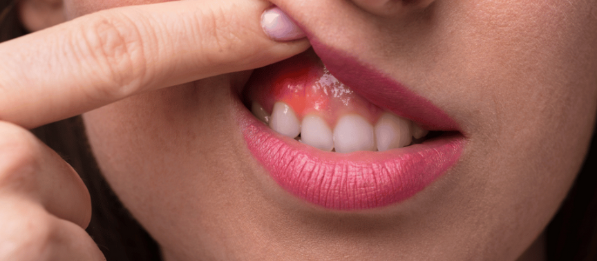 Can Castor Oil Reduce Gum Swelling and Infection? A Natural Remedy Explored