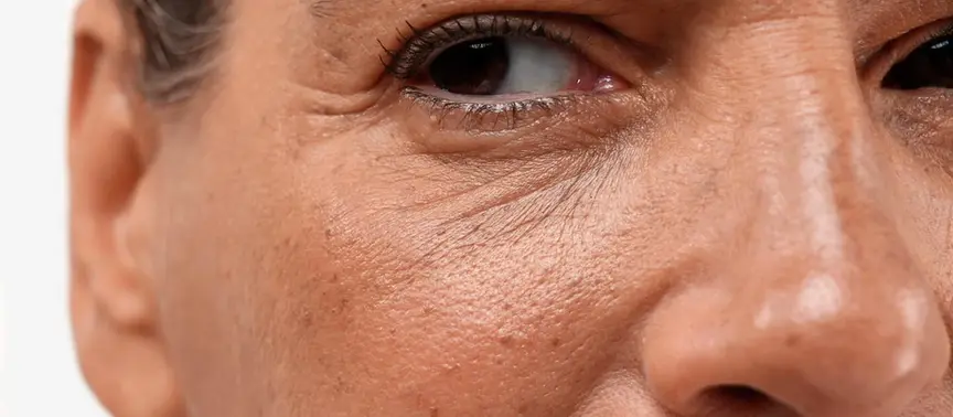 What Is the First Sign of Loss of Skin Density?