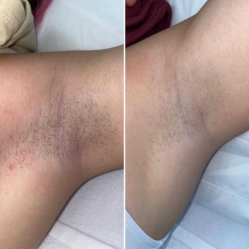 Hair Removal From The Armpit