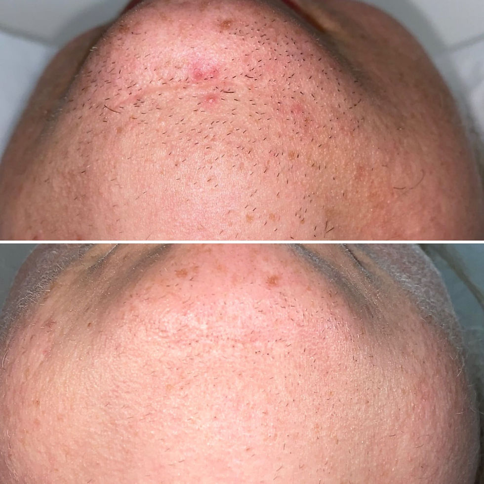 Chin Hair Removal