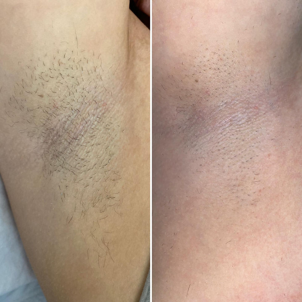 Armpit Hair Removal