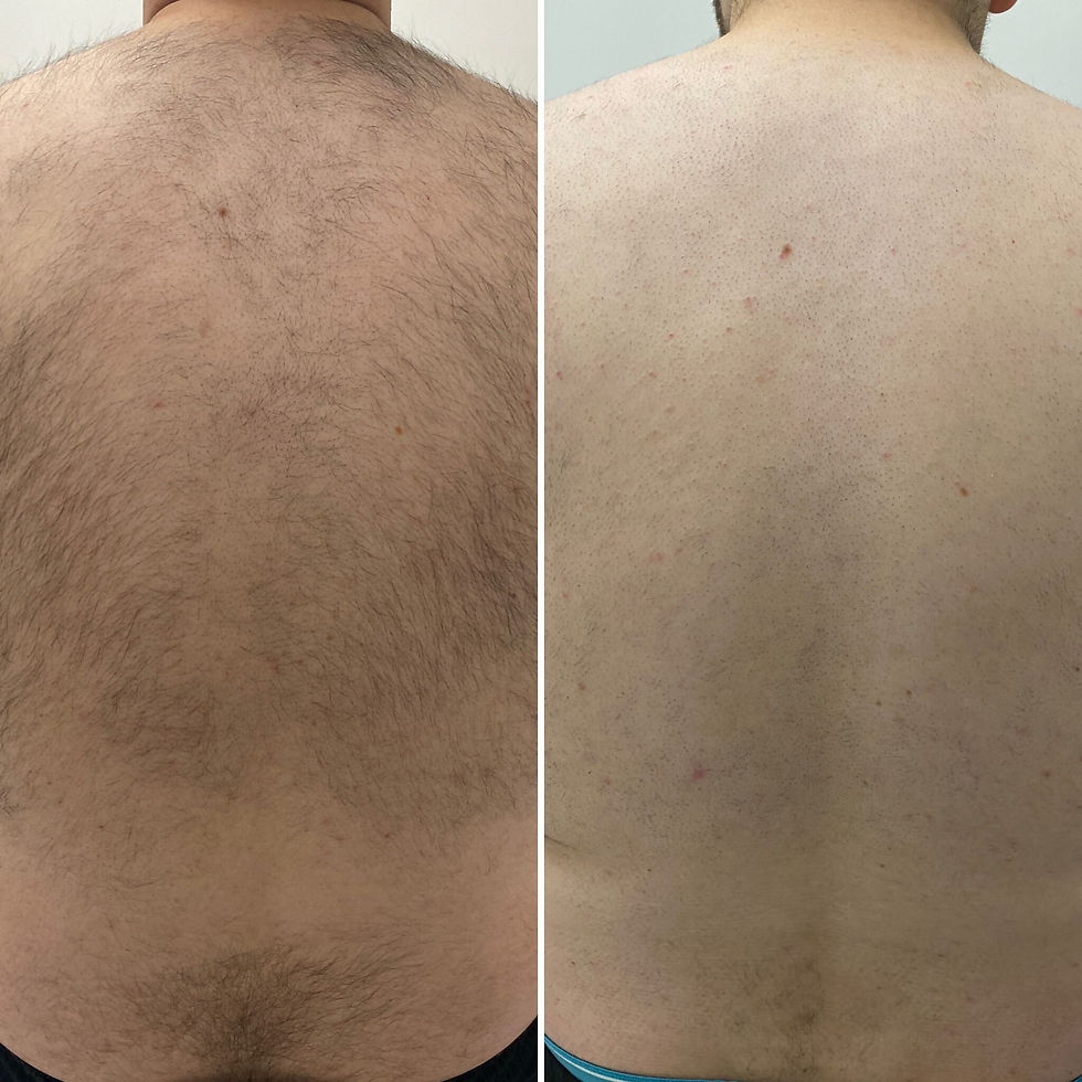 Hair Removal From The Back