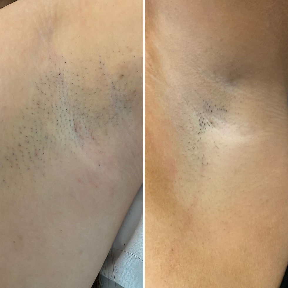 Armpit Hair Removal At The Laser Clique