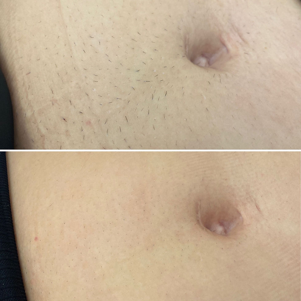 Hair Removal From The Belly Button