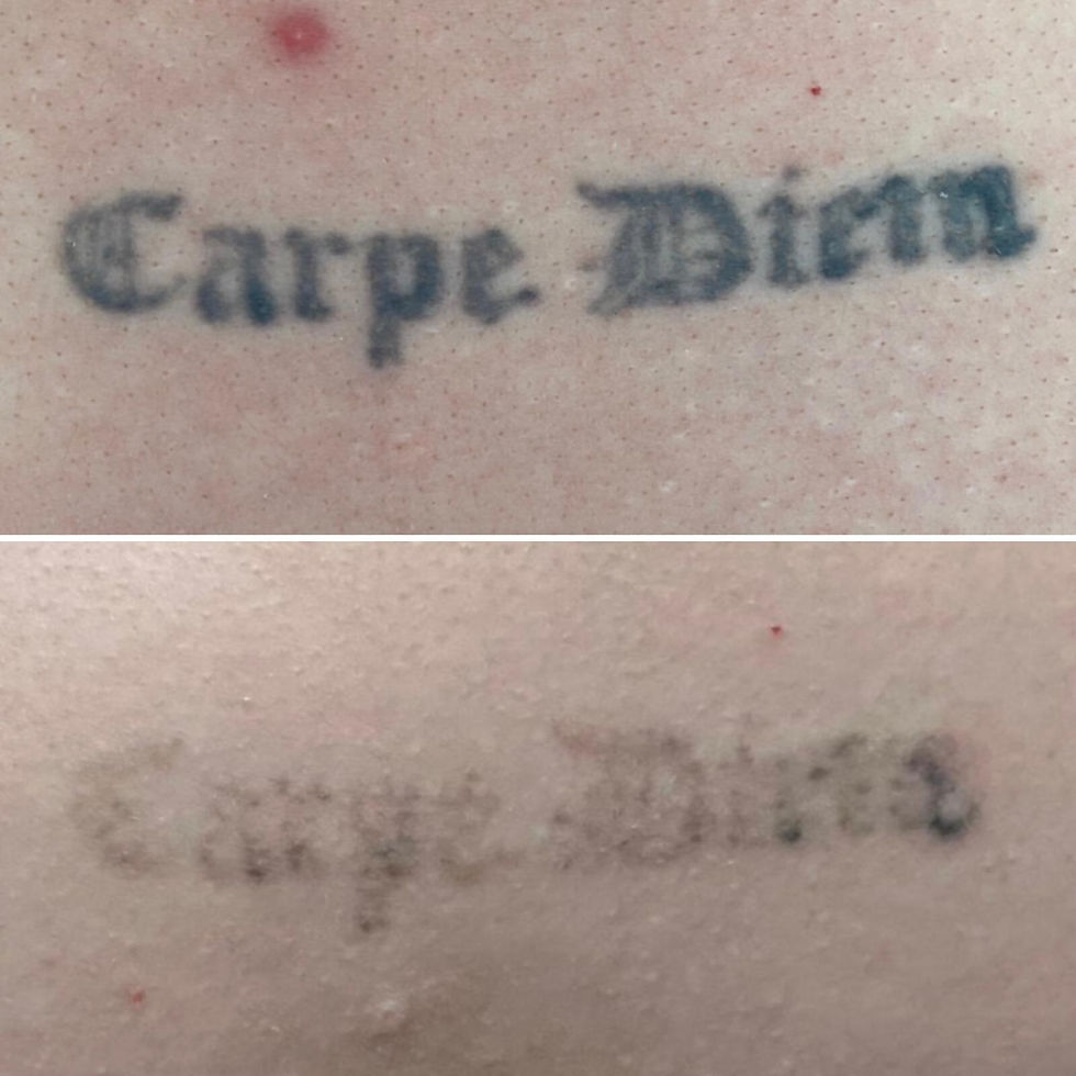 Tattoo Removal At The Laser Clique
