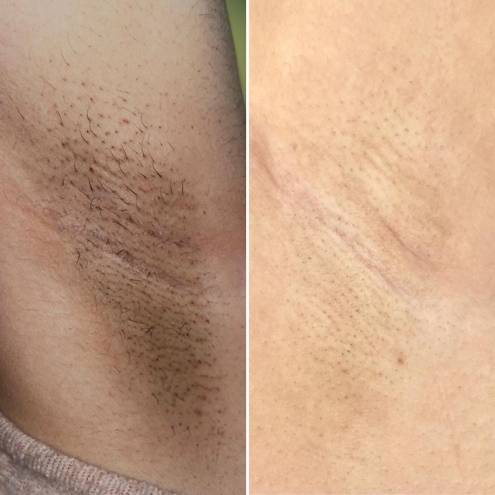 Complete Hair Removal