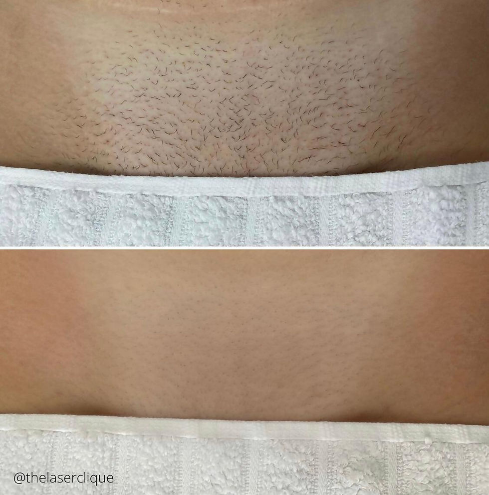 Hair Removal
