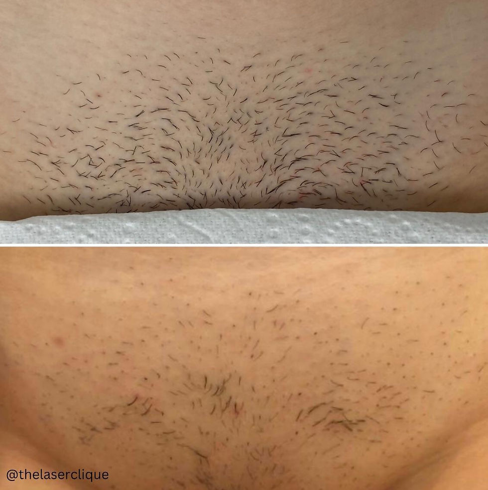 Hair Removal At The Laser Clique