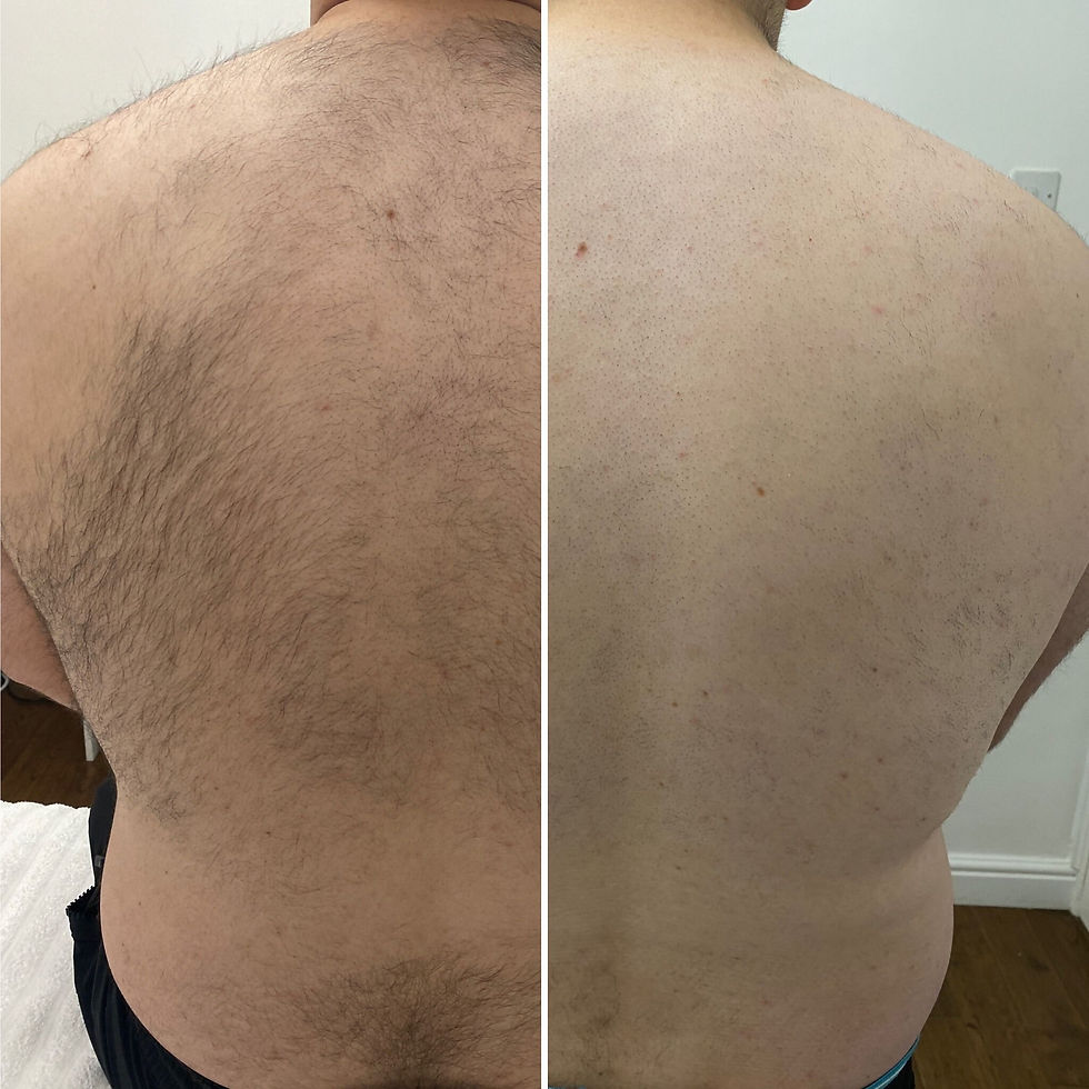 An image of hair removal