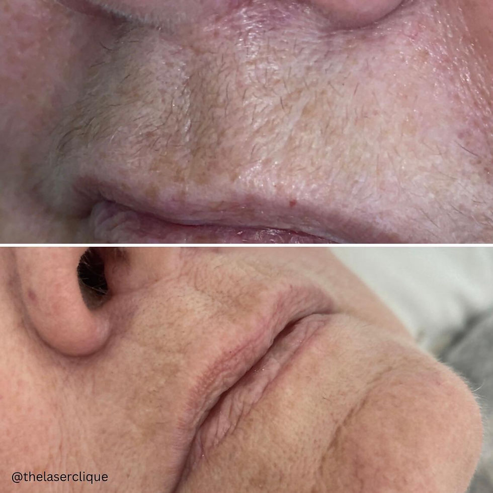 Hair Removal From The Top Lip