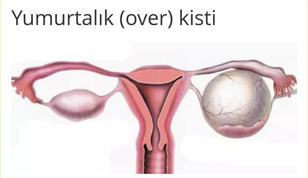 DOĞURGANLIK DÖNEMİNDEKİ KADINLARDA YUMURTALIK KİSTLERİ NASIL OLUŞUR? NASIL TEDAVİ EDİLİR?