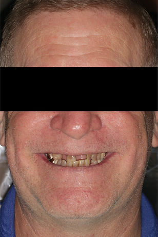 preop eyes covered FMR.jpg