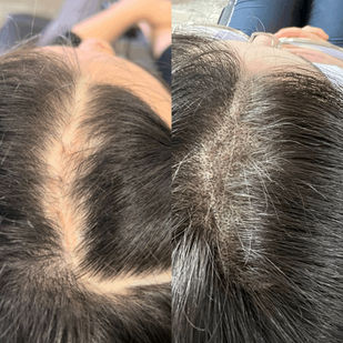 Scar camouflage for head scar before and after