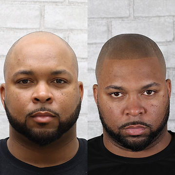 Scalp micropigmentation barber style hairline before and after