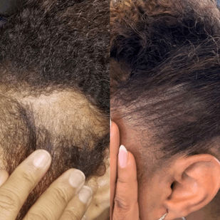 Scalp micropigmentation for thinning side edges before and after.