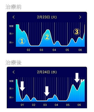 一目瞭然【鍼灸治療による睡眠改善の効果】