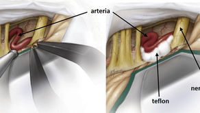 La decompressione microvascolare nell'emispasmo facciale 