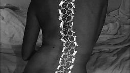 Scoliosis