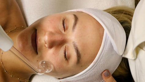 Facial Cleansing & Skin Needling