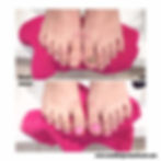 Ayak medikal Protez Tırnak Uygulaması