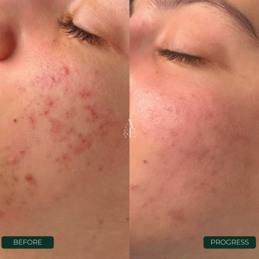 Mandelic Acid Peel