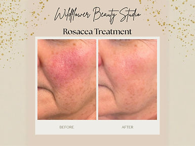 Laser Hair Removal, Before and After, Sharplight, Laser Technician, Dartmouth