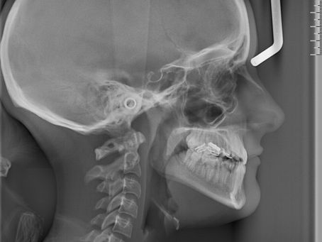 Sefalometri Filmi Nedir? Oran Çankaya Ankara’da Kullanım Alanları